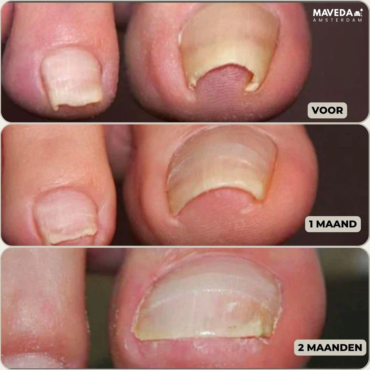 10+10 FREE | FixaNail™ - Instant nail repair