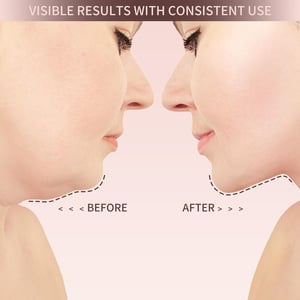 VitaLift - Tighten your facial features in a natural way