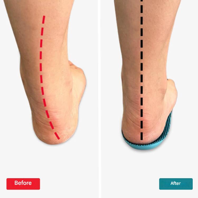 SoleCure – Pain-free steps from day one
